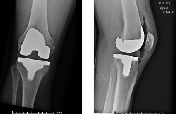 Radiographic views of Dr. Bozic's knee post-TKA