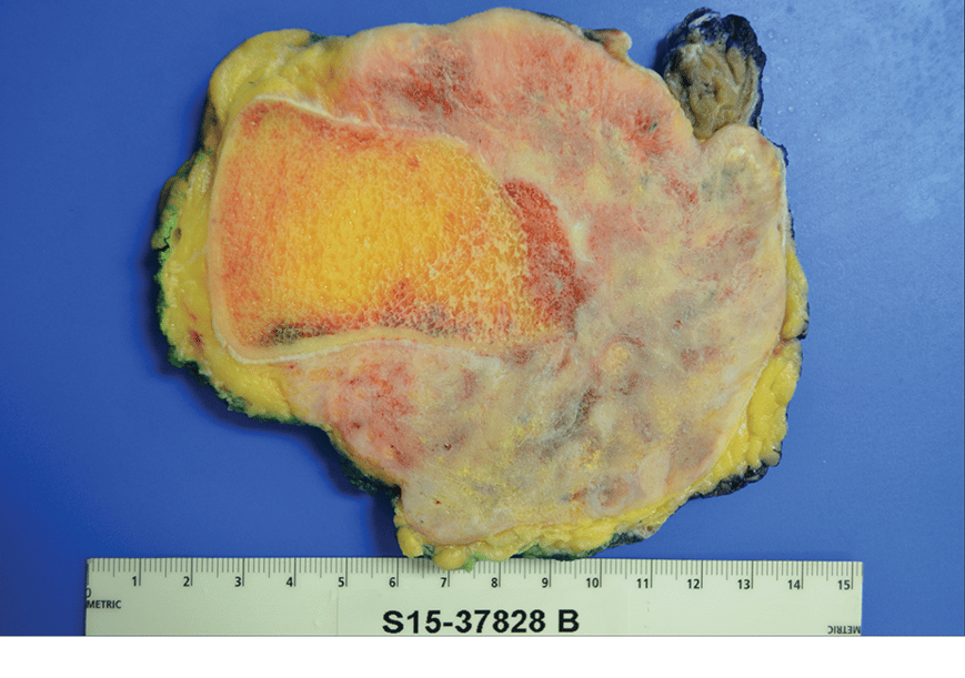 Resected specimen of a surface osteosarcoma