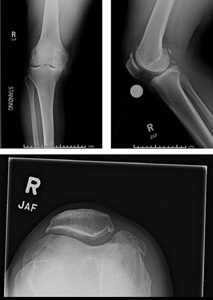 Radiographic views showing Dr. Bozic needed a TKA