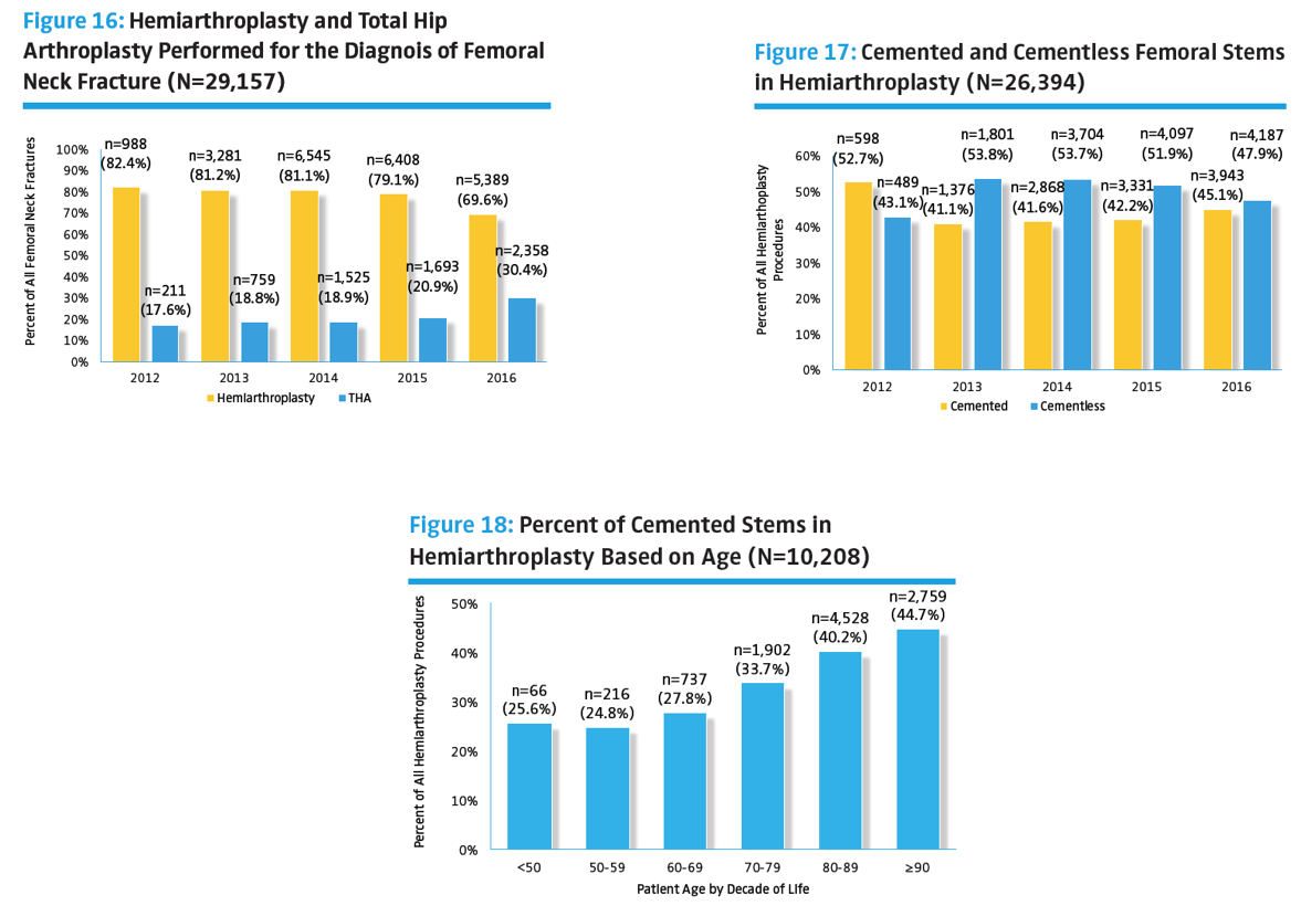 Hemiarthroplasty for the Treatment of Femoral Neck Fracture Diagrams